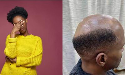 He embarrasses me at work - Woman cries out over her 31-yr-old husband's developing baldness - woman husband baldness